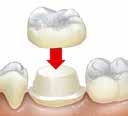 Shake XTR OptiBond OptiBond XTR o średnim thin4.with Airnastępnie thin medium with air medium airoptibond XTR z OptiBond XTR ADHESIVE. ADHESIVE ADHESIVE briefly. Apply briefl toy.