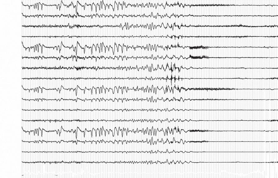 EKG pomiędzy napadami kołatania serca lub omdleniami Ryc. 2.