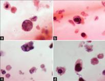 Zróżnicowanie obrazu decoy cells w rozmazie cytologicznym moczu (cytospin): a/ typ 1 inkluzji b/ typ 2 c/ typ 3 d/ typ 4 NEFROPATIA BKV - zapalenie śródmiąższowo-cewkowe - obecność wtrętów wirusowych