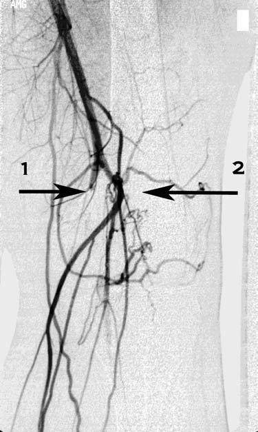 Popliteal artery entrapment, Halena et al. stingly, he never suffered from calf pain whilst riding a bike, even after distances of 50 70 kilometres.