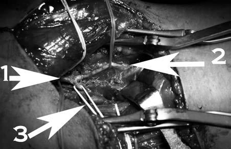 Acta Angiol., 2007, Vol. 13, No. 4 Figure 2. Popliteal fossa dissected.