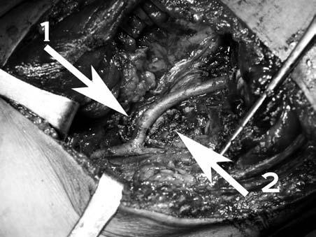 around the dominant sural artery (3). Patient's foot is on the right side of the photograph Rycina 2. Wypreparowane struktury dołu podkolanowego.