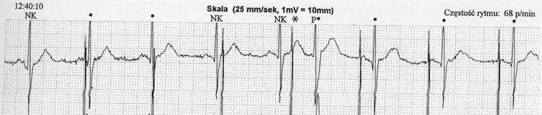 typie niedoczułość (ang. undersensing). Iglice w tym przypadku pojawiają się za własnym załamkiem P.