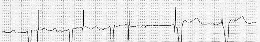 synchronizacji przedsionkowo komorowej w prawidłowym zapisie EKG widzimy iglicę stymulacji, a następnie pojawia się zespół QRS.