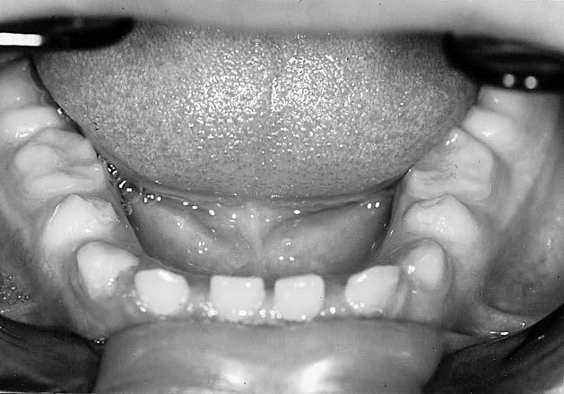 2. Pacjent M.W. uzębienie w wieku 9 lat Fig. 2. Patient M.W. dentition in 9 year old Ryc. 5.