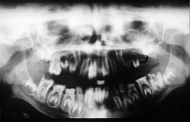orthopantogram Ryc. 9. Pacjent A. B.