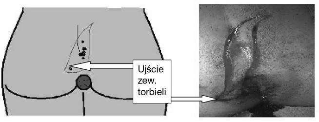 Metody leczenia operacyjnego torbieli pilonidalnej z pierwotnym zamknięciem rany i przemieszczeniem szpary pośladkowej noczesnym pierwotnym zamknięciem rany w sposób umożliwiający przemieszczenie