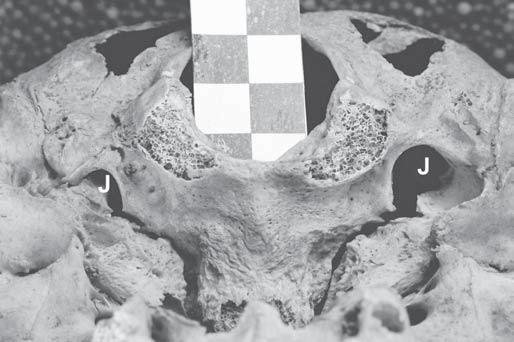 Wysocki J., Krasucki K., ywczyk.: Zaburzenia s³uchu i równowagi w anomaliach anatomicznych i wadach rozwojowych 179 Ryc. 3. Podstawa czaszki.