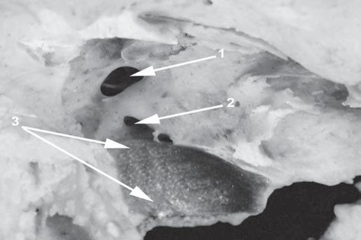 180 Otorynolaryngologia, 2005, 4(4), 177-182 Ryc. 4. Œciana przyœrodkowa jamy bêbenkowej. Wysoko ustawiona opuszka y³y szyjnej wewnêtrznej, przekraczaj¹ca poziom dolnej œciany jamy bêbenkowej 1.