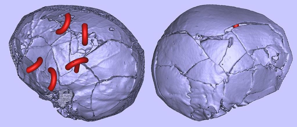 Obraz danych z TK zaimportowanych do programu graficzno-obliczeniowego Tak przygotowany wirtualny model fragmentu czaszki mógł zostać wytworzony na drukarce 3D, jednakże w wyniku poniesionych