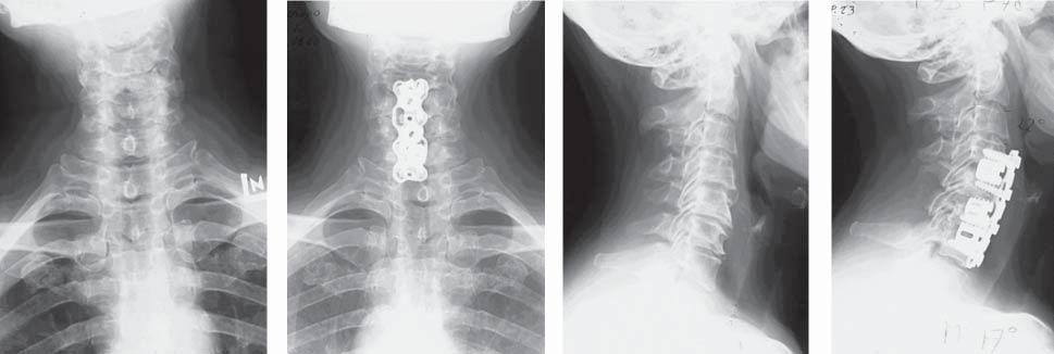 32 In 14 cases discectomy and fusion were made on one level, two levels were operated on 8 patients, three levels on three patients.