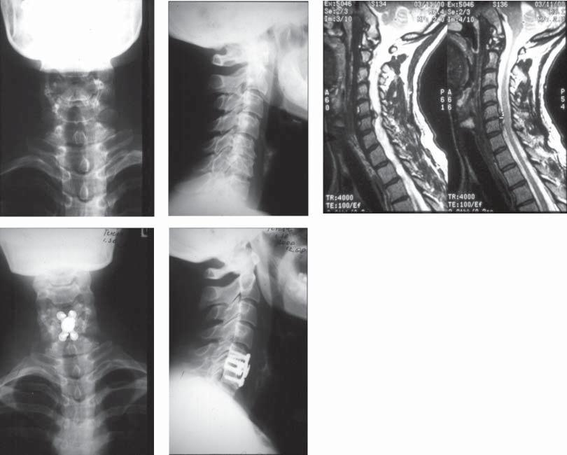 Results of treatment are presented in each group. To assess the results of treatment clinical assessment scale and radiological scale were used (NDI index and X-ray image.
