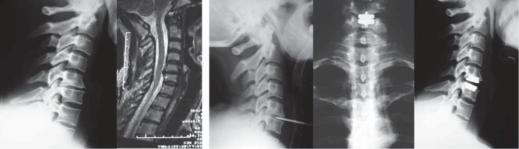 Adjacent segment syndrome in patients after cervical spine spondylodesis 33 functional x-rays was performed, and mobility of the adjacent segments to the operated level was assessed.