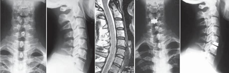 Described group of patients were compared with a similar group of patients in which dyscectomy and implantation of artificial disk was made.