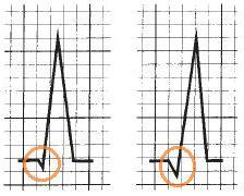 Zespół QRS Prawidłowa amplituda zespołów QRS Gdy suma R i S w odprowadzeniach kończynowych wynosi poniżej 5 mm, a w odprowadzeniach przedsercowych poniżej 10 mm, jest to tzw.