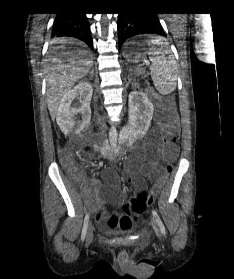 Ponadto obecnie stosowana jest klasyfikacja urazów tego narządu zaproponowana przez Amerykańskie Stowarzyszenie Chirurgii Urazowej AAST (American Association for the Surgery of Trauma) (4).