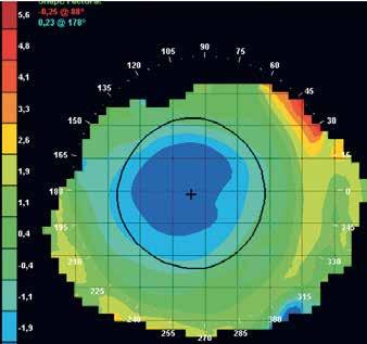 Dzięki uprzejmości Menicon Co. Desirable topography flattening in the central area, bull s eye pattern. Courtesy of Menicon Co. Ryc. 4.