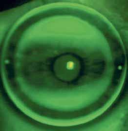 Dzięki uprzejmości Menicon Co. The impact of retinal defocus (a) on axial elongation (b). Defocus compensated by orthokeratology lens (c). Courtesy of Menicon Co. Ryc. 3.