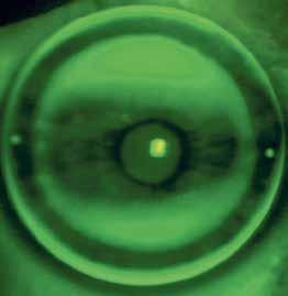 Dzięki uprzejmości Menicon Co. The impact of retinal defocus (a) on axial elongation (b). Defocus compensated by orthokeratology lens (c). Courtesy of Menicon Co. Ryc. 3.