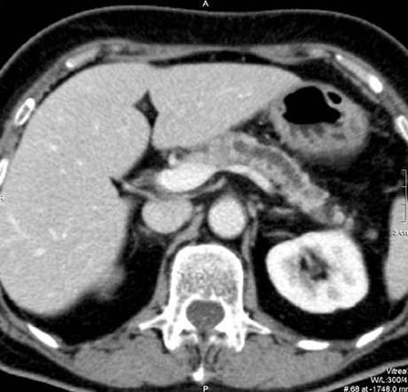 Diagnostyka przedoperacyjna guzów trzustki 139 a b Ryc. 1. Gruczolakorak trzonu trzustki Badanie TK, obrazy po podaniu środka kontrastowego w fazie tętniczej (a) i żylno-wrotnej (b); angiografia TK (c).