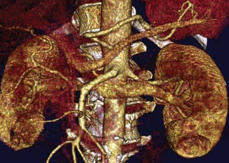 Angiografia TK ujawnia wariant unaczynienia w postaci odejścia prawej tętnicy wątrobowej i tętnicy wątrobowej wspólnej od tętnicy krezkowej górnej