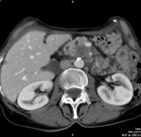 Diagnostyka przedoperacyjna guzów trzustki 141 a b c d Ryc. 3.
