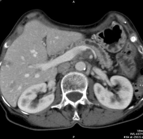 Cechy nacieczenia żyły śledzionowej i żyły krezkowej górnej ze zredukowaniem ich światła (a, b, d) Fig. 3. Adenocarcinoma of the head of pancreas CT after i.v.