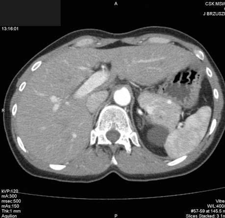 Multiple insulomas CT after i.v. contrast administration, arterial phase (a, b, c).
