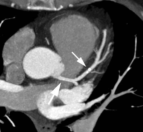 przednia lewej têtnicy wieñcowej (du a strza³ka) oraz prawa têtnica wieñcowa (ma³a strza³ka) Fig. 1. Visualization of the coronary arteries by 64-slice CT.