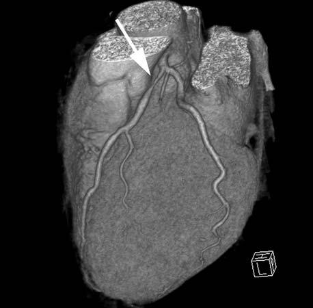 A - transaxial image showing the stenosis in the proximal left anterior descending coronary artery (arrow), B - multiplanar reconstruction of the left anterior descending coronary artery.