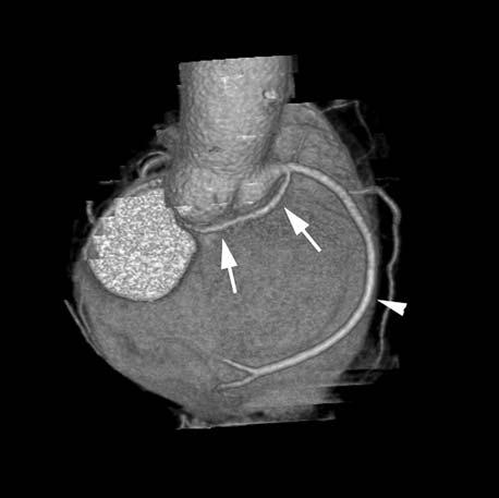 It originates from the right sinus of Valsalva and takes a course dorsal and caudal to the aortic root towards the left coronary groove.
