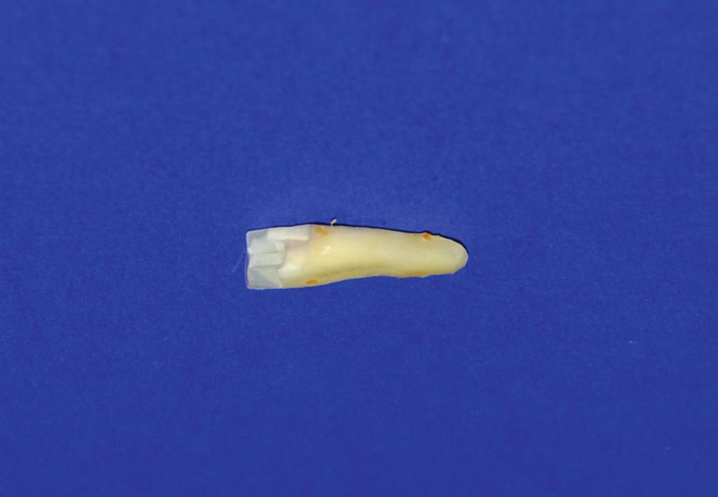 Wkłady zespolono z korzeniami za pomocą cementu Core-X Flow (Densply, USA) przy użyciu systemu wiążącego V generacji XP Bond (Densplay, USA) wraz z aktywatorem Self Cure Activator (Dentsply, USA).