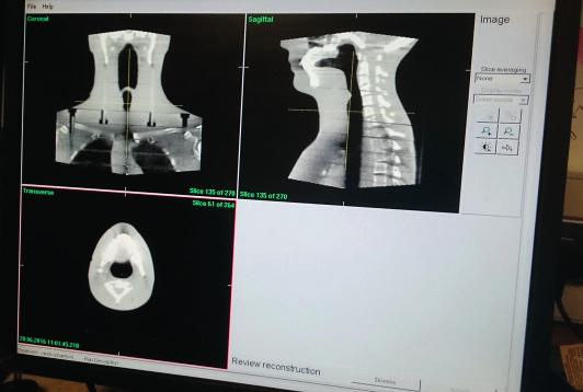 artykuł naukowy / scientific paper radioterapia / radiotherapy W ocenie jednorodności przyjęto za wartości referencyjne wyniki uzyskane z obrazów testowych dla fantomu CATPHAN dla wszystkich FOV.