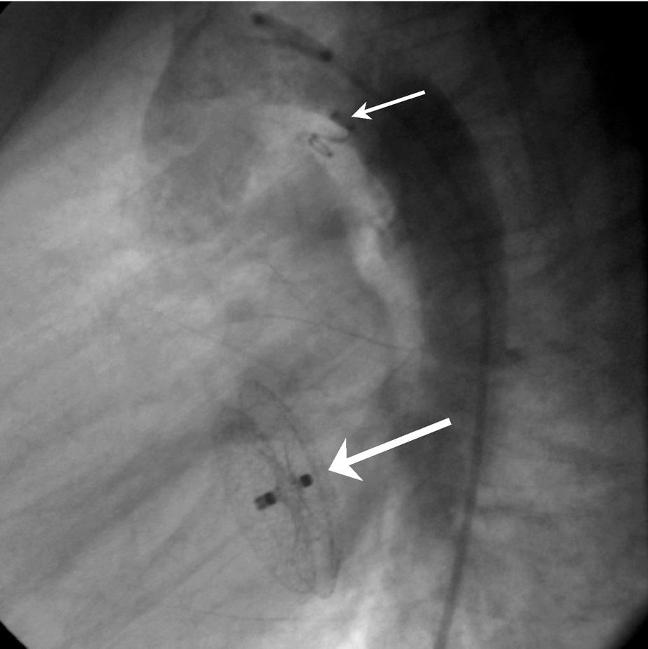 Folia Cardiol. 2004, tom 11, nr 11 piono stent do lewej tętnicy płucnej, diagnozowano z powodu przyrostu desaturacji systemowej (79 80%).