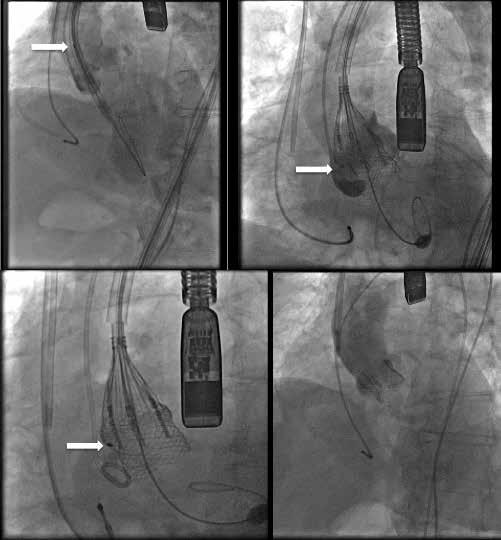 Marek Grygier et al. The procedure was conducted under general anaesthesia.