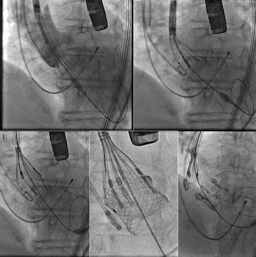 The small Lotus introducer (18 F) and 270 mm delivery wire were used. Subsequently, balloon valvuloplasty was performed using a 20 18 mm Z-Med (Numed) balloon.