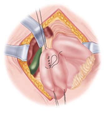98 Część III Chirurgia żołądka odźwiernik żołądek miejsce nacięcia pęcherzyk żółciowy dwunastnica Rycina 13-2 Rycina 13-3 Przed nacięciem