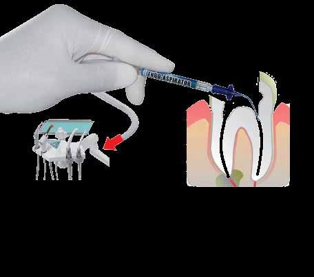 ENDO-ASPIRATOR ENDO-ASPIRATOR do odsysania płynów z kanału korzeniowego ułatwia osuszanie kanału korzeniowego przyspiesza pracę (nawet 10x!