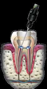 Kiedy powtórzyć leczenie endodontyczne?
