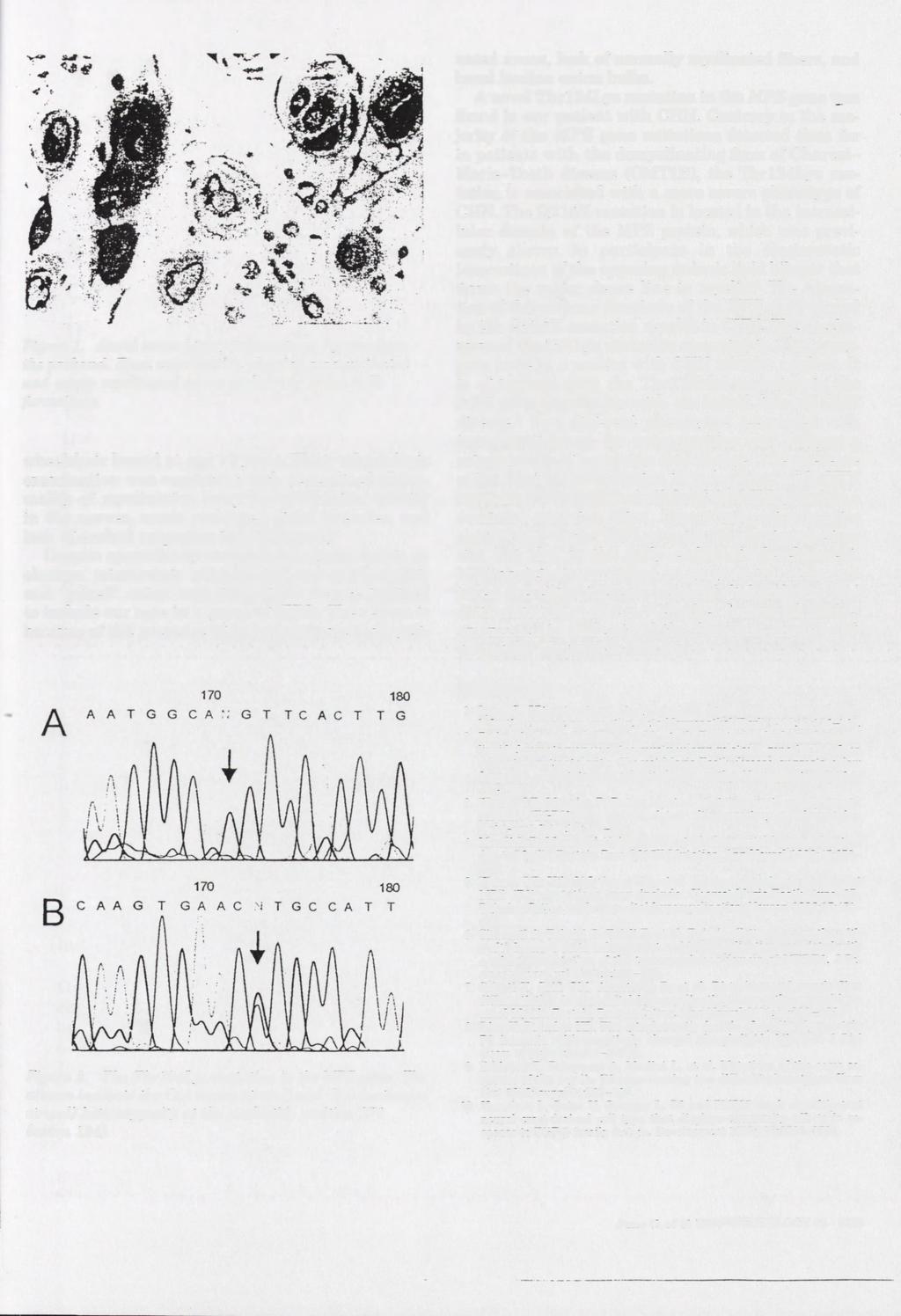 Figure 1. Sural nerve biopsy taken at age 7 years from the proband. Epon cross-section showing nonmyelinated and poorly myelinated axons enclosed by onion bulb formations.