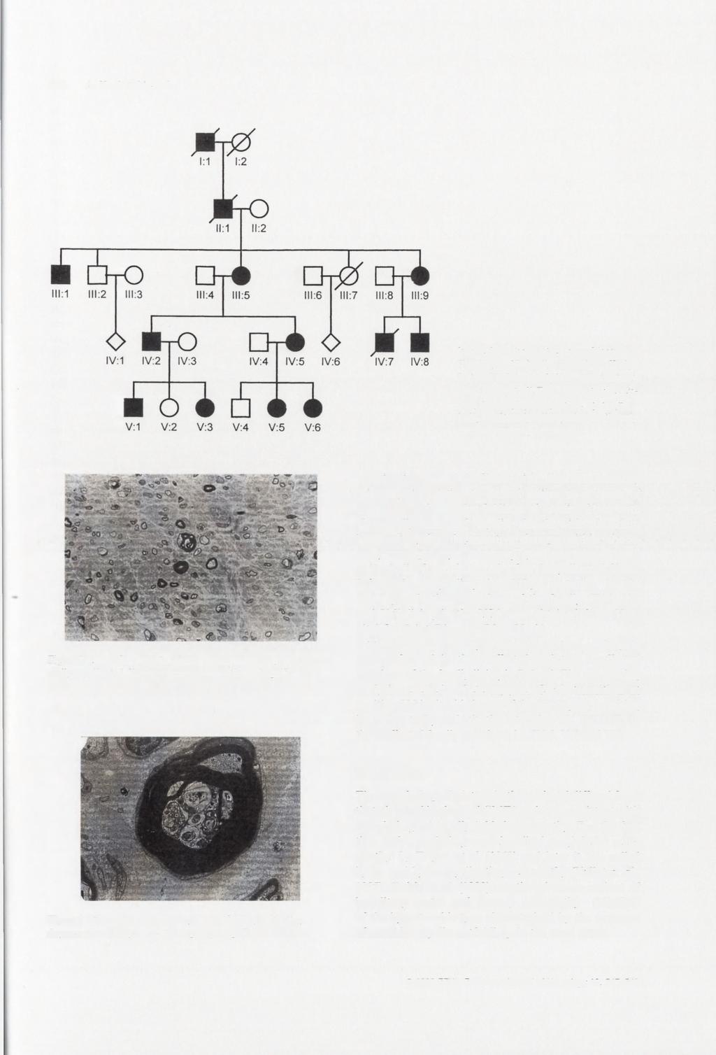 548 A. Kochański et al. Figure 1 Pedigree of Charcot-Marie- Tooth type IB family. In patients IV:5, V:5 and V:6 the Asn 131 Lys substitution in third exon of MPZ gene was found.