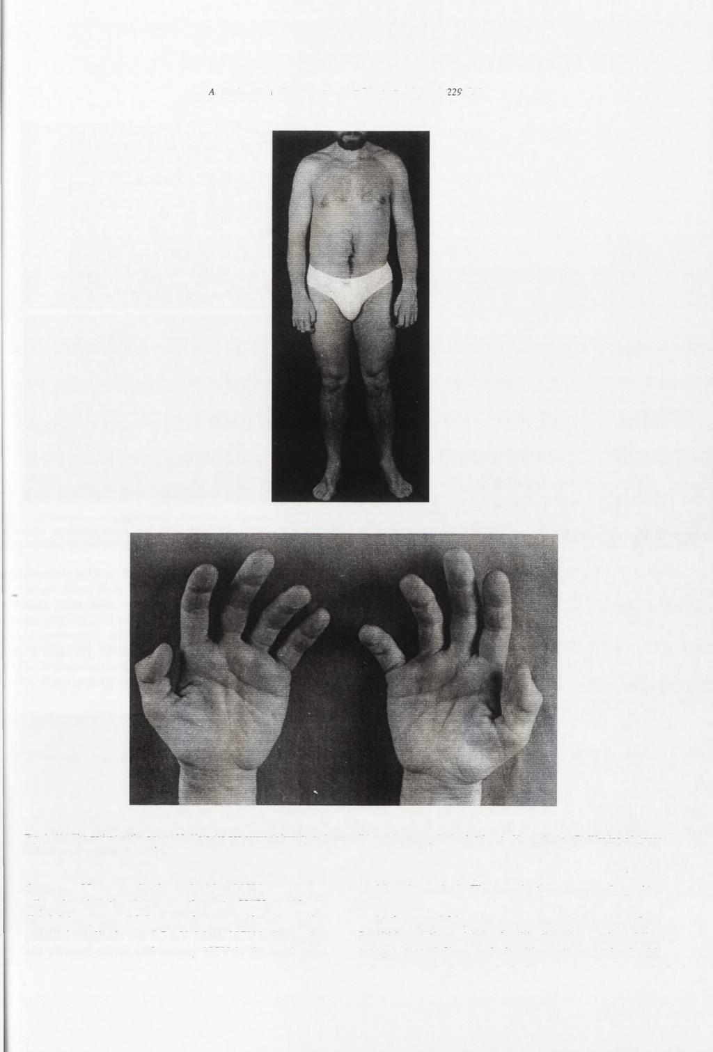 230 >4. Kochanski el al. / Neuromuscular Disorders 14 (2004) 229-232 231 A B Fig. 1. (A) The patient at the age of 39.