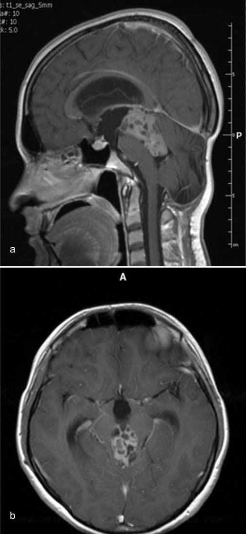 Neurofizjologiczna protekcja struktur nerwowych podczas operacji guzów pnia mózgu Ryc. 1a, b. Egzofityczny guz pnia mózgu histopatologicznie nerwiak ośrodkowy, WHO II.