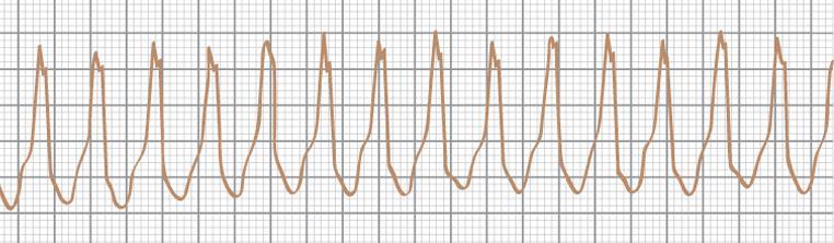 TACHYARYTMIA - CZĘSTOSKURCZ Wąski QRS-