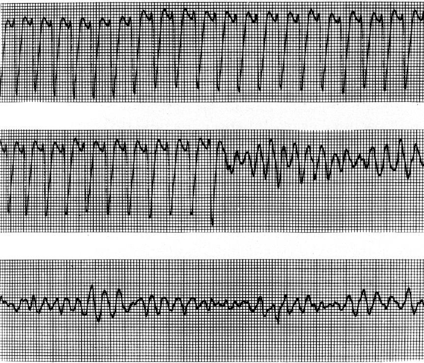 Sustained VT Degeneration to VF