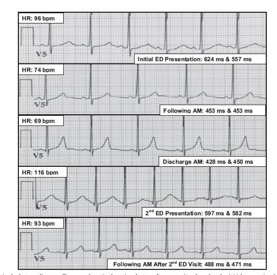 Congenital type 1 long QT syndrome unmasked by a highly caffeinated energy drink (Keith A. Dufendach*, Justin M. Horner, MD, MPH,* Bryan C. Cannon, MD, FHRS, Michael J.