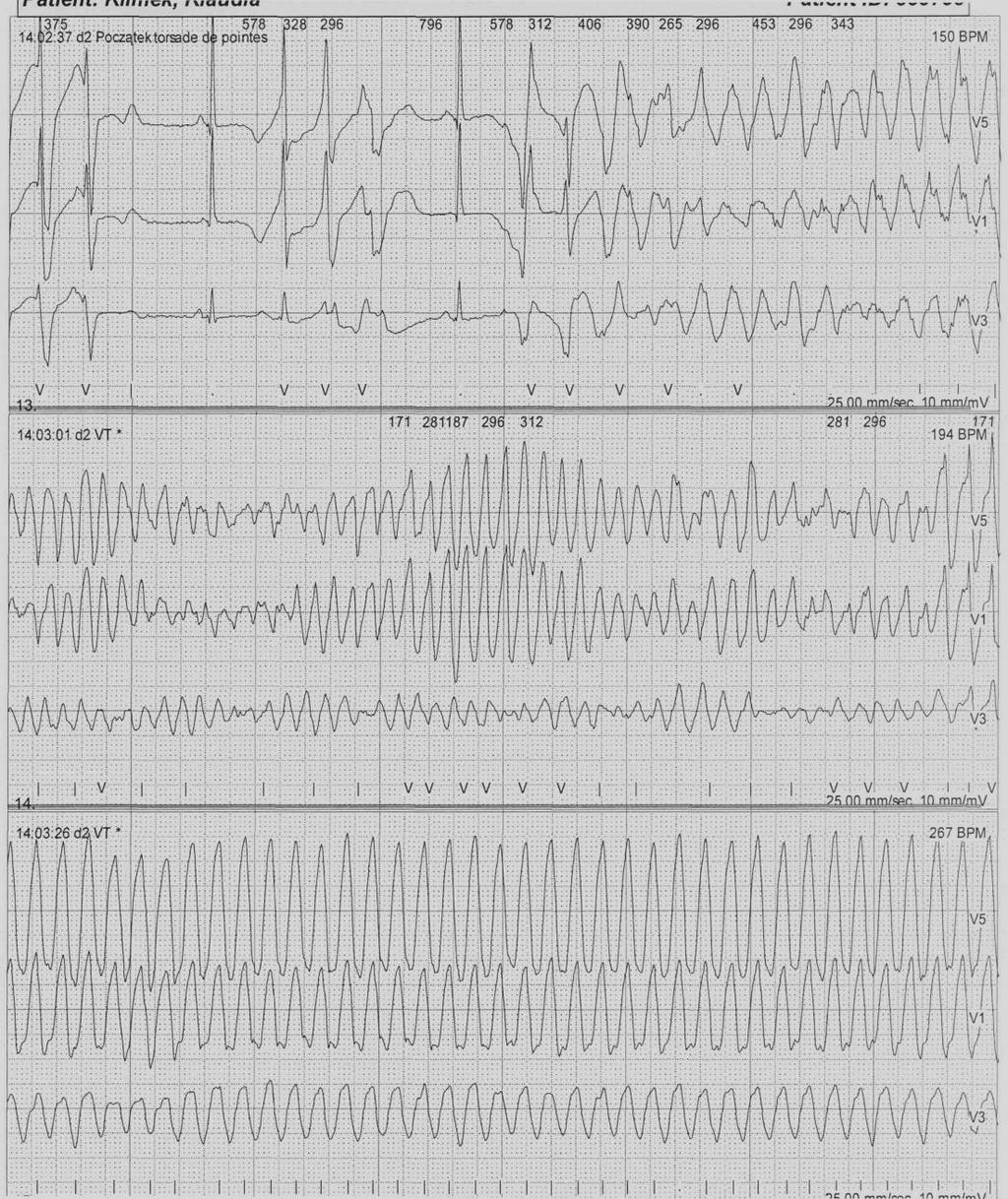 WIELOKSZTAŁTNY CZĘSTOSKURCZ KOMOROWY TORSADE DE POINTES TdP 12-letnia dziewczynka Od 7. roku życia (od 2002 roku) leczona z powodu utrat przytomności na padaczkę różnymi lekami.