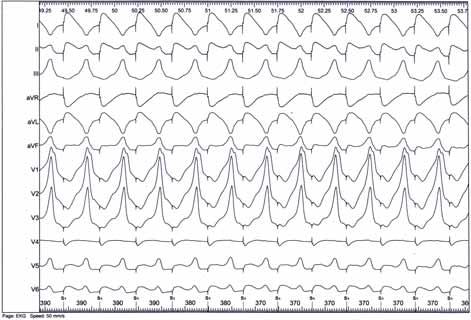 Folia Cardiologica 2015, tom 10, nr 2 Rycina 2. Fragment zapisu z 24-godzinnego monitorowania elektrokardiografi cznego metodą Holtera Rycina 3.