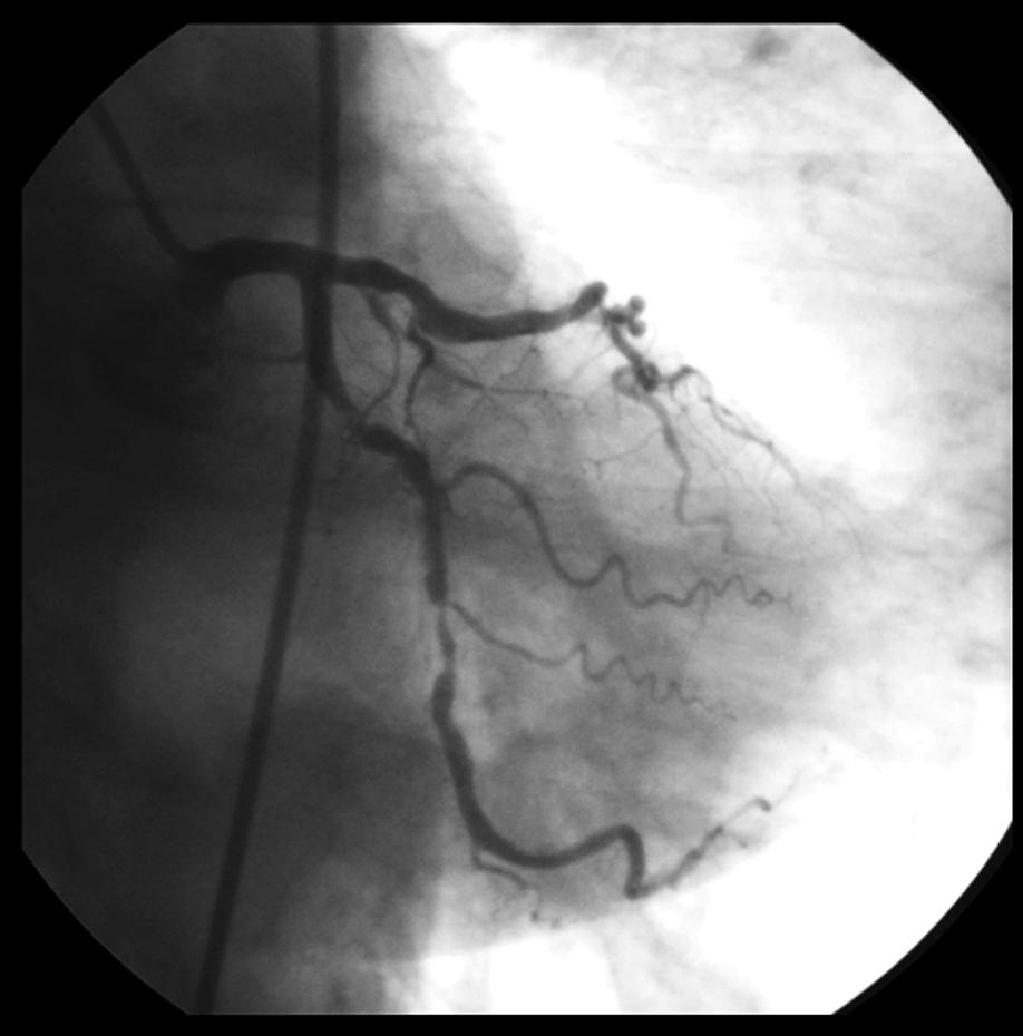 1293 Etapowa przezskórna angioplastyka tętnic wieńcowych jako metoda leczenia trójnaczyniowej choroby wieńcowej... LAD 80-90% LAD Cx Cx 70% Cx 90% Rycina 1.