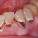 pentasiarczanu (VI) diwodorotlenku tetrażelaza (III). Pacjent z ciężką próchnicą na linii dziąseł wskutek suchości jamy ustnej spowodowanej lekami.